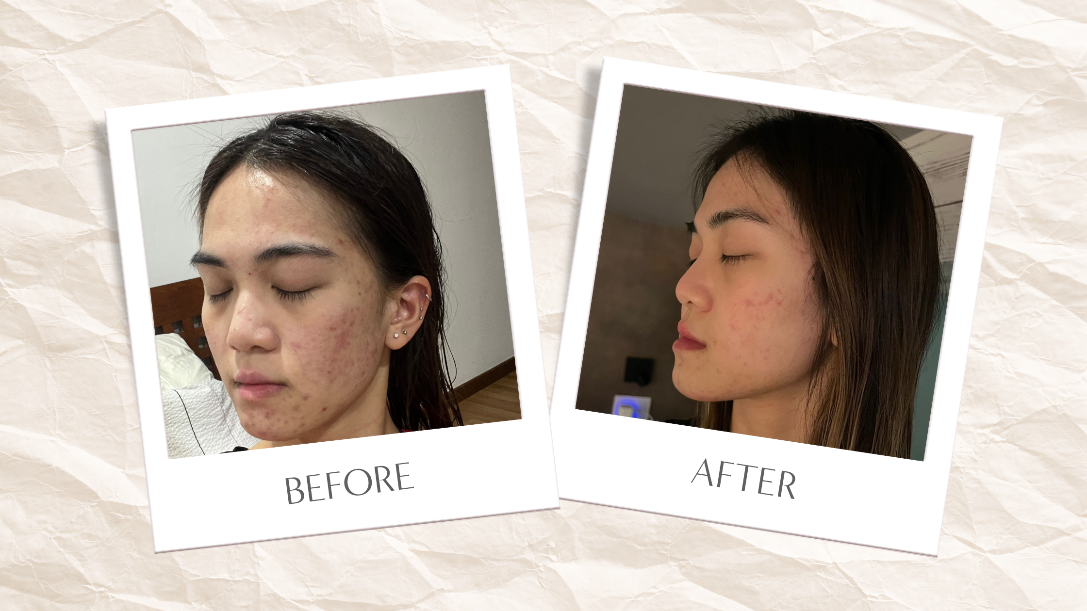 I’ve Been Fighting Acne Since My Teens