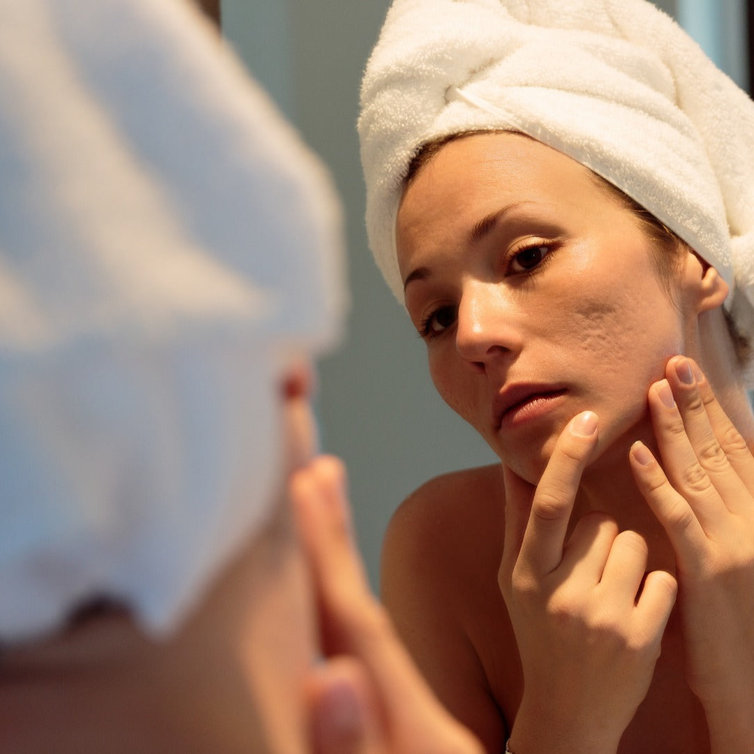 Avoid these food if you are dealing with acne!