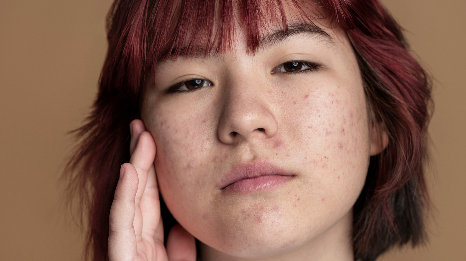 Beyond Perfect Skin: Redefining Beauty Standards with Acne and Pigmentation