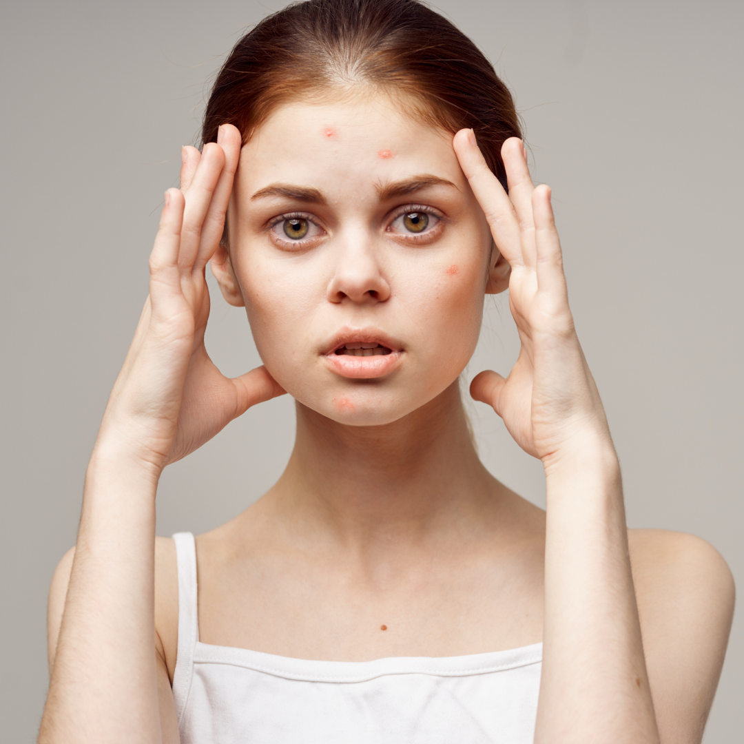 Beat that acne and be confident!