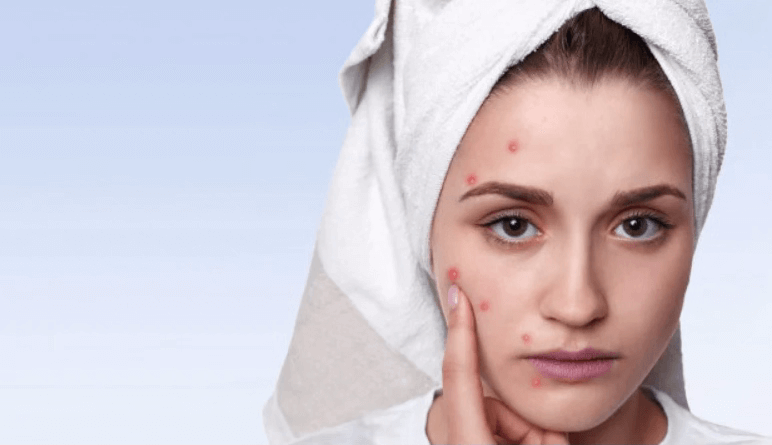 How to Reduce Breakout & Pigmentation Effectively