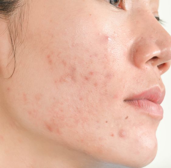 Acne Treatment Collection