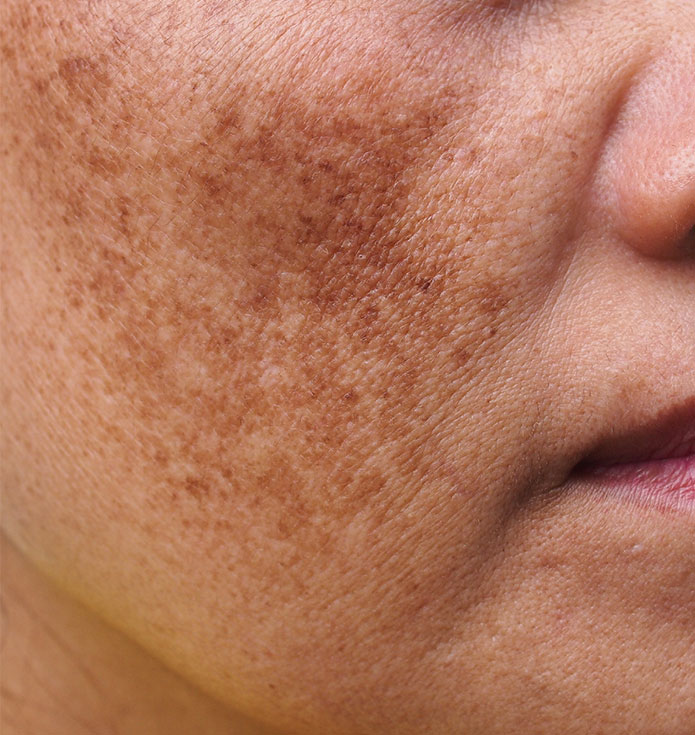 Pigmentation & Melasma Treatment Collection