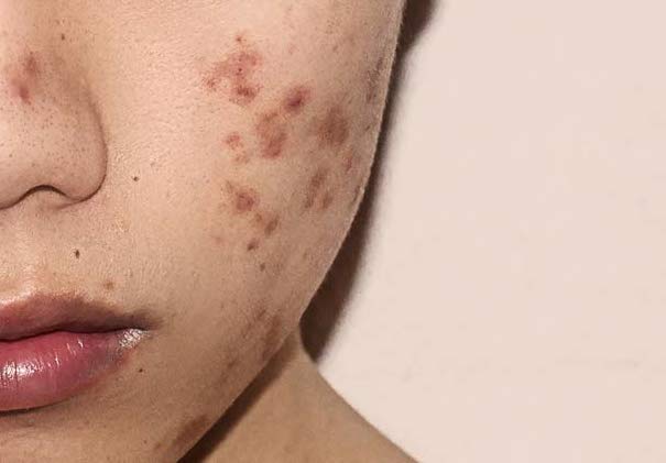 Dark Scar Treatment Collection