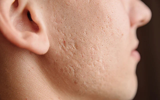 Deep Scar Treatment Collection