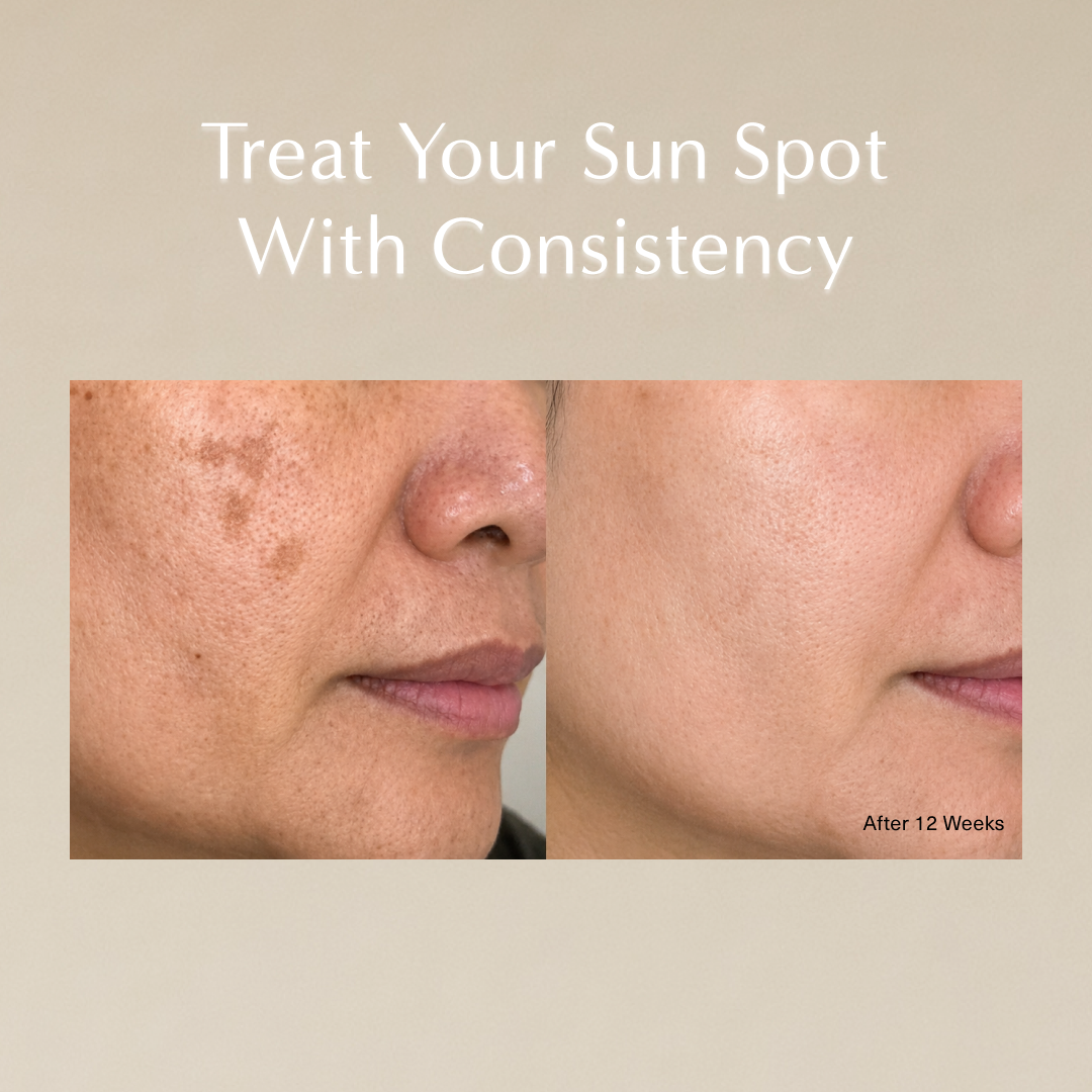 Sun Spot Defense