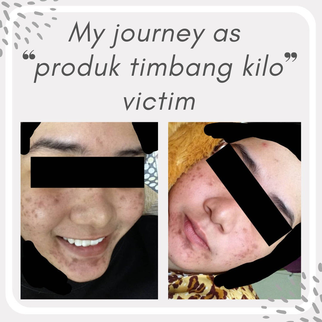 Mercury skincare survivor: How I treat my damaged skin