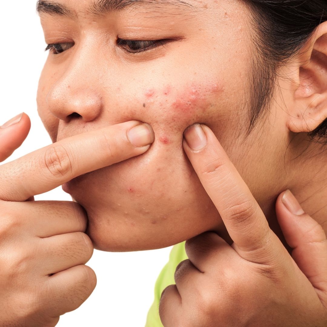 Having acne? What are the things you should avoid?