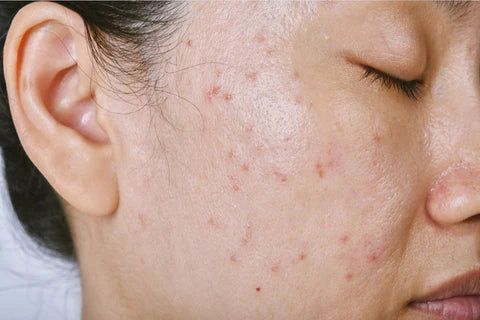 How to Get Rid of Dark Spots: Causes, Treatments, and Prevention Tips