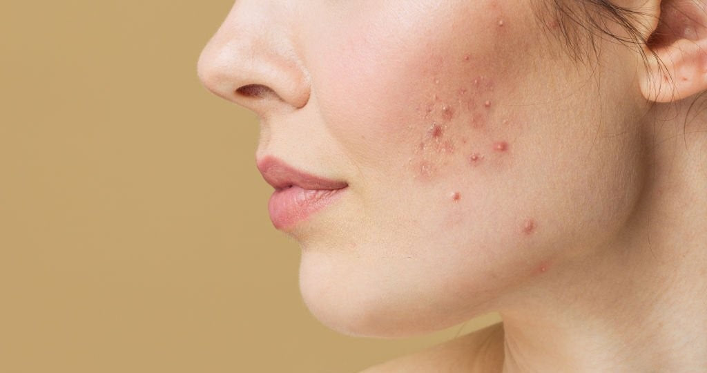 Common Causes of acne you need to know