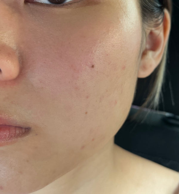 After treatment - Week 12