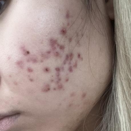 After treatment - Week 1