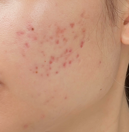 After treatment - Week 4