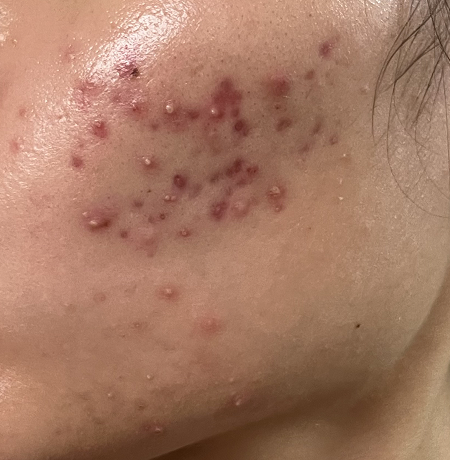 After treatment - Week 2