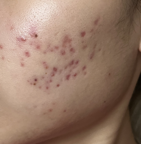 After treatment - Week 3